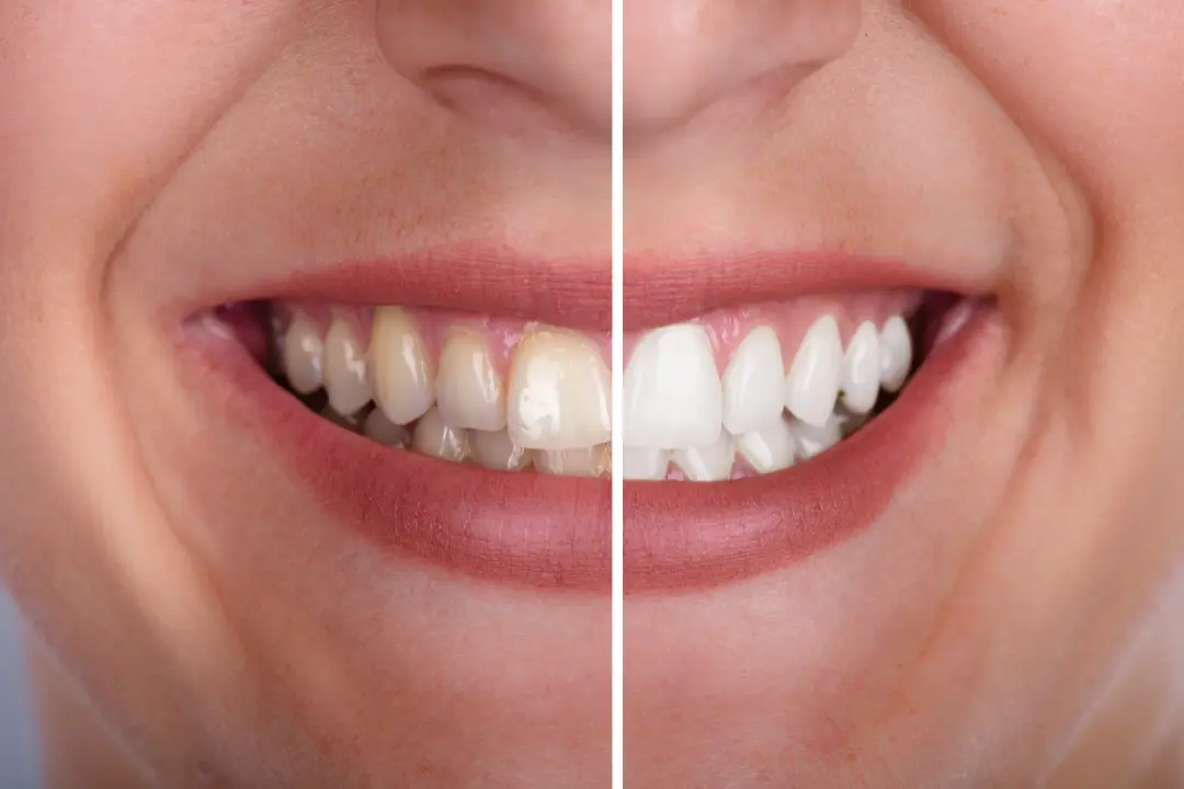 Facetas dentárias e o Clareamento dental